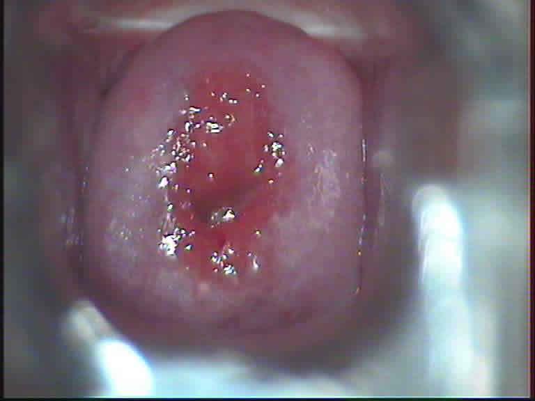 轻度一度宫颈糜烂图片