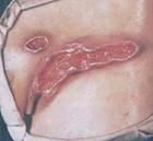 女性软下疳图片