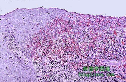 宫颈发炎图、慢性宫颈发炎图片