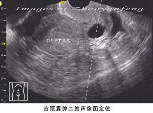 宫颈囊肿的图片