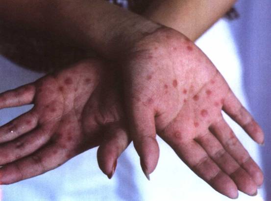 斑疹性梅毒疹道图