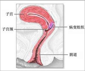 子宫内膜异位症图
