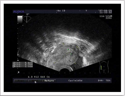 盆腔积液的治疗哪种方法好