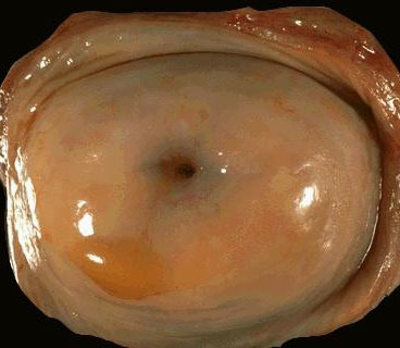 宫颈肥大患者图片及宫颈肥大道图