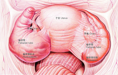 治疗慢性附件炎