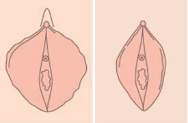 阴唇整形图修复前修复后