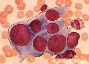 子宫癌早期症状图片