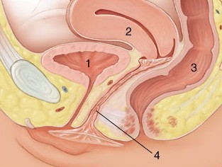 女性避孕套使用道人图