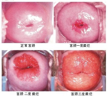 二三度宫颈糜烂图片