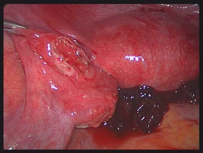 宫外孕早期症状图片