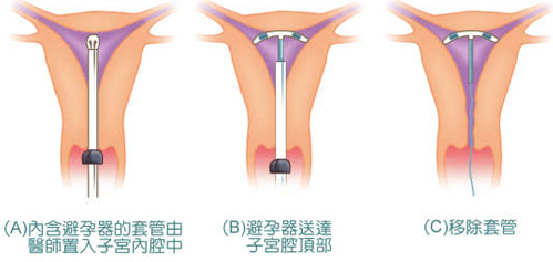 女性上环避孕方式