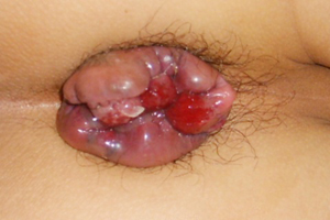 女性内痔疮图片