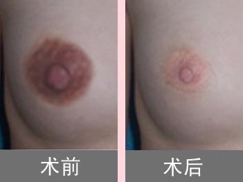 红色乳晕图片,黑色乳晕图片