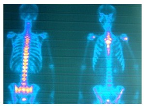 强直性脊柱炎图片
