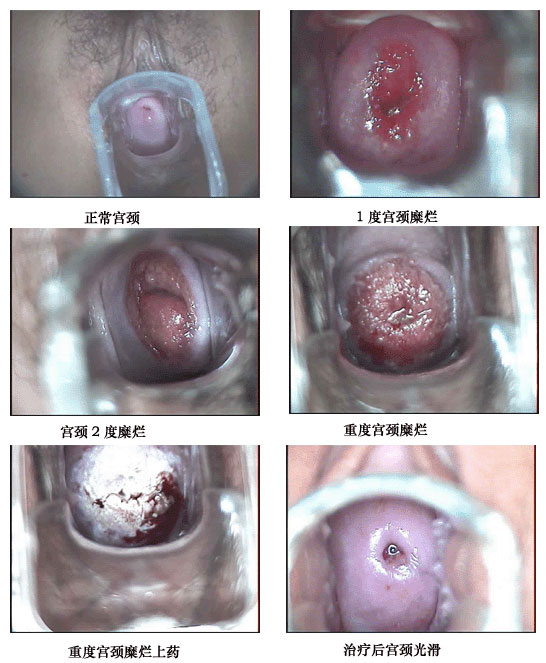 宫颈潴留囊肿图片