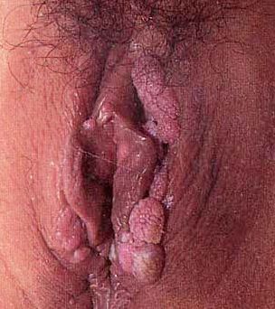 一期尖锐湿疣图片