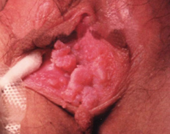 一期尖锐湿疣图片