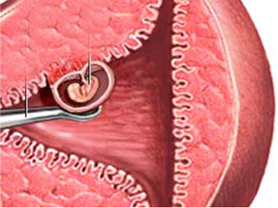 子宫肌瘤内膜息肉图片