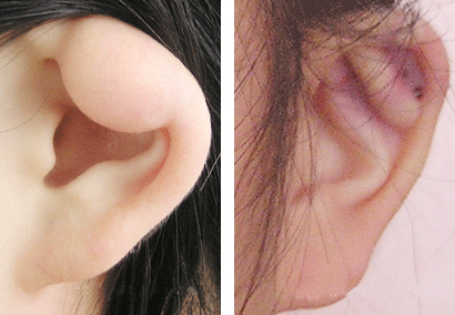 外耳原发癌症图