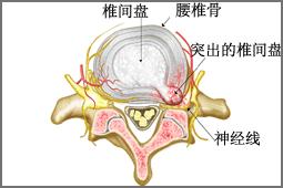 腰间盘突出症状图