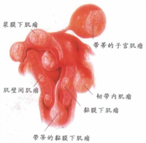 女性盆腔炎图片