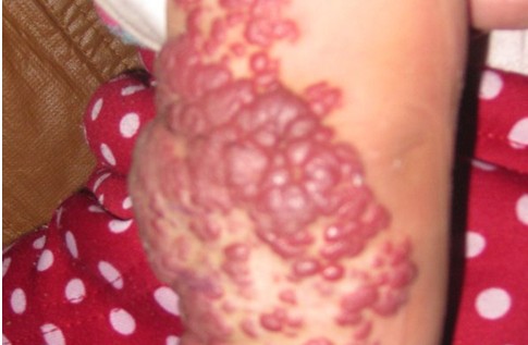 血管瘤早期症状图片
