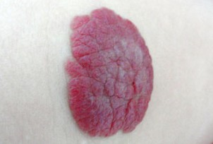 血管瘤的症状图片
