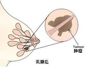 乳腺癌的早中期症状图片
