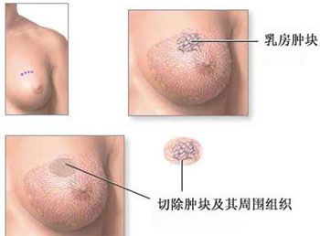乳腺癌的早期图片