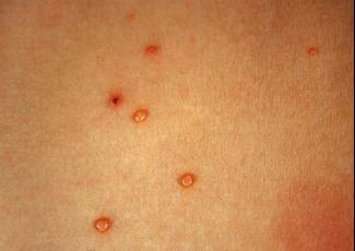 传染性软疣初期图片