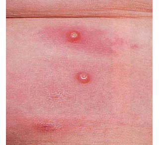 传染性软疣初期图片