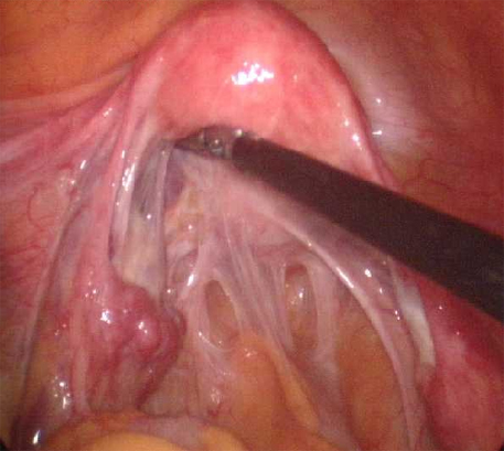 盆腔粘连实物图片
