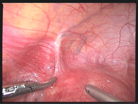 女性盆腔粘连实物图片