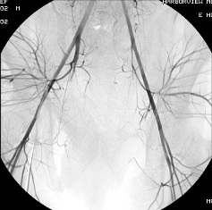 女性盆腔血管实物图