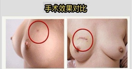  乳腺纤维瘤切除疤痕
