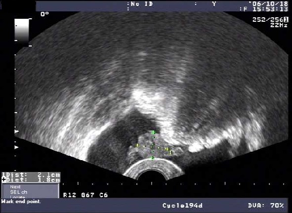 盆腔积液多少正常图片