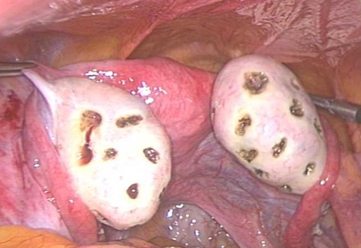 多囊卵巢综合症打孔手术实物图片