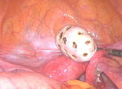 
多囊卵巢b超图片