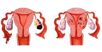 左则附件囊肿图片