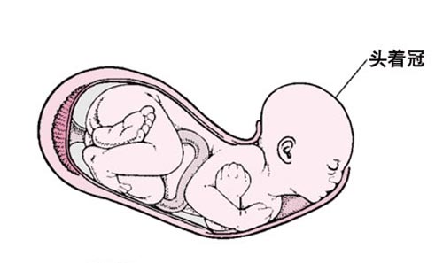 顺产无痛分娩图片