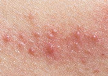 女性尖锐湿疣图片