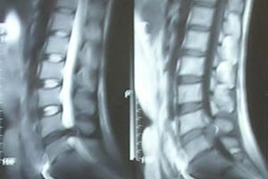 腰椎间盘突出症的症状道图